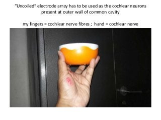 “Uncoiled” electrode array has to be used as the cochlear neurons
present at outer wall of common cavity
my fingers = cochlear nerve fibres ; hand = cochlear nerve
 