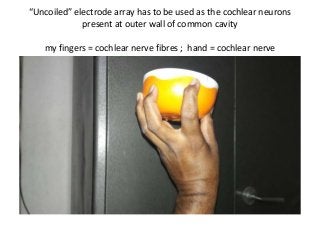 “Uncoiled” electrode array has to be used as the cochlear neurons
present at outer wall of common cavity
my fingers = cochlear nerve fibres ; hand = cochlear nerve
 