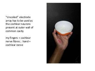 “Uncoiled” electrode
array has to be used as
the cochlear neurons
present at outer wall of
common cavity
my fingers = cochlear
nerve fibres ; hand =
cochlear nerve
 