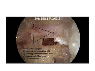 SV ( Scala Vestibular ) Drilling has to be done in the same arch of ST ( Scala
Tympani ) drilling & Middle turn drilling has to be done in the same arch of SV
drilling – while drillouts we should not injure the OSL ( Osseus spiral laminae )
because neurons will damage
 
