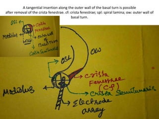 PARS ( = PARTS ) of Cochlea
 