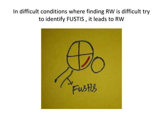 The lecture of this PPT present in youtube video ( Cochlear
implant surgery concepts )
https://www.youtube.com/watch?v=aRnKkjiJHn4&t=203
0s
abnormal cochleas lecture videos present in
https://www.youtube.com/playlist?list=PLZquE6mn0cym
Eae9sQZK2N_1AVIFNjttd
 