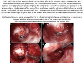 Grades of ossification
 