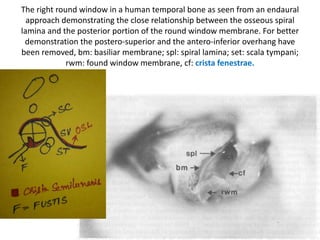 Grade III: both the scala tympani and scala vestibuli of the basal
turn are ossified, while the middle and apical turns are patent. This can occur
with the ascending part of the basal turn being accessible (IIIA) or inaccessible
(IIIB)
 