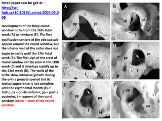 PARISIER'S TRIANGLE
(DANGEROUS TRIANGLE)
Perisier's triangle is very important triangle in cochlear implant surgery
1) Superior limb is formed by inferior part of HFN
2) The apex is formed by the geniculate ganglion
3) The base is formed by the anterior commissure (end) of oval window
4) Inferior limb is formed by tunning point of jocobson's nerve to the the
geniculate ganglion.
 