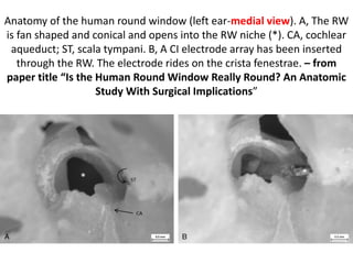 Wall of Parisier’s triangle is by “ wall of middle turn cochlea ” & cavity
is by “ cavity of middle turn ” - & labyrinthine part of facial nerve stays
above the middle turn cochlea which may be stimulated by CI
electrode array causing facial twichings .
 