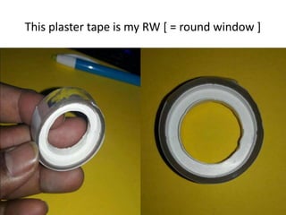 Relation of middle turn
cochleostomy in relation
to dangerous triangle
 