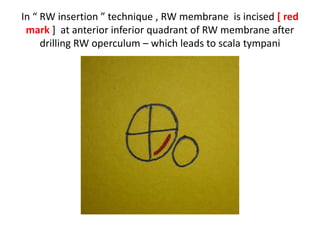OW = oval window ; RW = round window ; H = Helicotrema
OW & RW & H forms 90 degree
triangle
Centre of OW roughtly
corresponds to groove for tensor
tympani
 