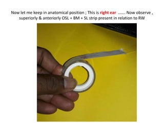 So it is the 3rd part of the electrode/cochlea which is causing facial twistings . So in
Programming we have to stop that electrode . Facial twistings commonly affects in
pathological & abnormal cochleas like Otosclerosis & common cavity respectively . How it
effects AVT [ Audio-verbal therapy ] I will explain in next slides .
 