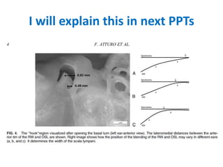 Perisier's triangle ( dangerous triangle ) which denotes labyrinthine part of
facial nerve…….. Corresponds exactly to middle turn drillout
 