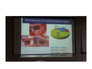 Prof. Proctor – variations of RW
• • Fossula fenestrae rotundae lata
• • Fossula fenestrae rotundae alta
• • Fossula fenestrae rotundae ovalis
• • Fossula fenestrae rotundae lateritia
• • Fossula fenestrae rotundae quadrata
• • Fossula fenestrae rotundae trapezoides
• • Fossula fenestrae rotundae rhomboidea
• • Fossula fenestrae rotundae semilunaris
• • Fossula fenestrae rotunda rotundae
• • Fossula fenestrae rotundae triangularis
• • Fossula fenestrae rotundae semicircularis
• • Fossula fenestrae rotundae dentata
• • Fossula fenestrae rotundae spinosa
• • Fossula fenestrae rotundae trabecularis
 