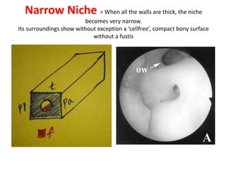 Upper OW & lower RW
t= tegmen - tegmen & anterior
pillar & posterior pillar all together
called as “ operculum ” by
some CI surgeons .
ap= Anterior pillar
pp= Posteriror pillar
Su=Subiculum
f= Finicullus
Fu= Fustis
Scc= Sub cochlear canal leads to
petrous apex
CM = Comcomerata medialis
CL = Comcomerata lateralis
Anterior pillar continues as
finicullus ; posterior pillar
continues as Subiculum
SCC [ Subcochlear canal ] present
between two “F” words i.e., Fustis
& Finicullus - CI surgeons
mistakenly pass CI electrode array
into this SCC .
 