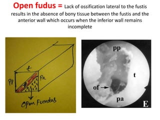 Exostosis = The most frequent
variation is exostosis near the entrance
of the niche
 
