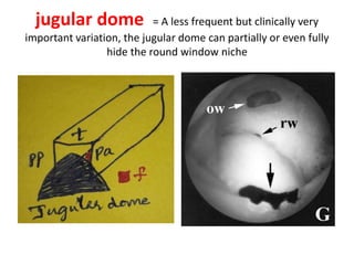 trabeculae niche is protected by
trabecules of varying sizes
 