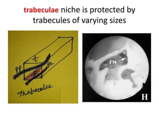 Narrow Niche = When all the walls are thick, the niche
becomes very narrow.
Its surroundings show without exception a ‘cellfree’, compact bony surface
without a fustis
 