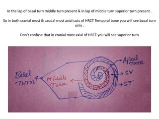 Anterior septum = The most frequent variation of the round
window entrance is the lamellar growth of the postis anterior which covers the
majority of the opening of the round window. The shape of the postis anterior
shows a wide variability from a continuous plate to the trabecular form
 