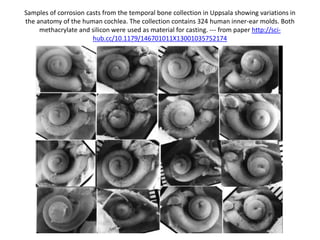 Bony membrance = In the rarest
variation the pseudomembrane is partially or completely ossified
in the round window’s entrance and forms a thin bony plate
 