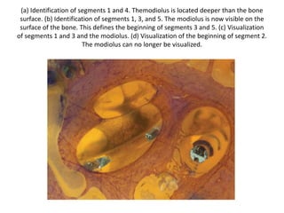 3. Peri - RW area
a. Fustis
b. SCC = Subcochlear Canal
 