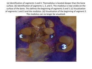 ENDOSCOPIC anatomy of Operculum
aio: anteroinferior overhang; po: postero-superior overhang;
cf: crista fenestrae.
 