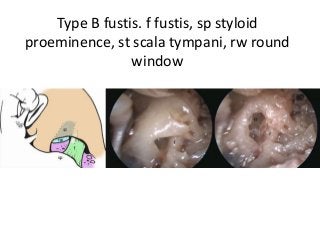 Type B fustis. f fustis, sp styloid
proeminence, st scala tympani, rw round
window
 