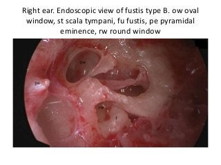 Right ear. Endoscopic view of fustis type B. ow oval
window, st scala tympani, fu fustis, pe pyramidal
eminence, rw round window
 