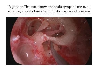 Right ear. The tool shows the scala tympani. ow oval
window, st scala tympani, fu fustis, rw round window
 