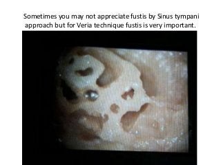 Sometimes you may not appreciate fustis by Sinus tympani
approach but for Veria technique fustis is very important.
 