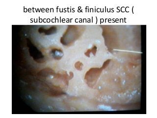 between fustis & finiculus SCC (
subcochlear canal ) present
 