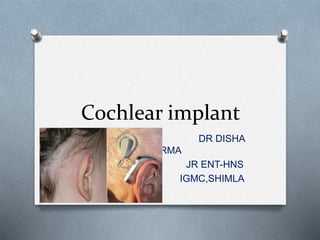 Cochlear implant
DR DISHA
SHARMA
JR ENT-HNS
IGMC,SHIMLA
 