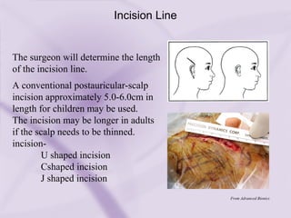 What Is Incision Line Cochlear implant (3) | PPT