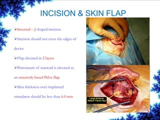 INCISION & SKIN FLAP
Inverted – J shaped incision.
Incision should not cross the edges of
device
Flap elevated in 2 layers
Periosteum of mastoid is elevated as
an anteriorly based Palva flap.
Skin thickness over implanted
stimulator should be less than 6.0 mm
 