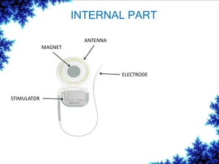 INTERNAL PART
MAGNET
ANTENNA
STIMULATOR
ELECTRODE
 
