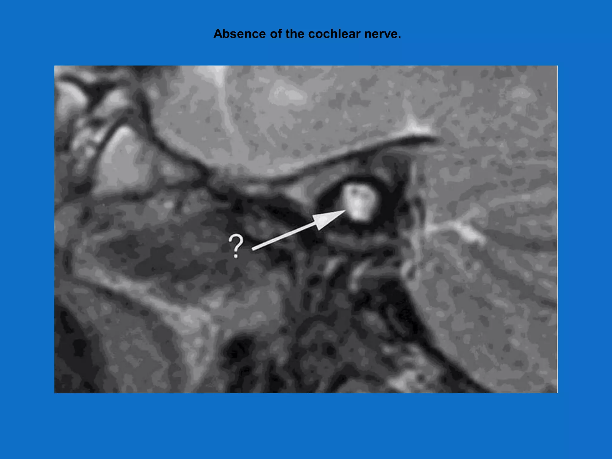 Absence of the cochlear nerve.
 