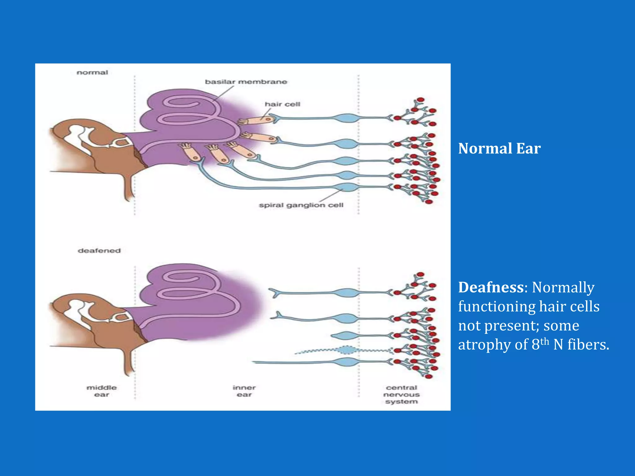 Normal Ear




Deafness: Normally
functioning hair cells
not present; some
atrophy of 8th N fibers.
 