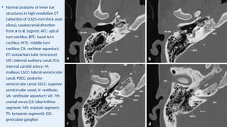• Normal anatomy of Inner Ear
structures in high-resolution CT
(selection of 0.625-mm thick axial
slices); caudocranial direction
from a to d. Legend: ATC: apical
turn cochlea; BTC: basal turn
cochlea; MTC: middle turn
cochlea; CA: cochlear aqueduct;
ET: eustachian tube (entrance);
IAC: internal auditory canal; ICA:
internal carotid artery; M:
malleus; LSCC: lateral semicircular
canal; PSCC: posterior
semicircular canal; SSCC: superior
semicircular canal; V: vestibule;
VA: vestibular aqueduct; VII: 7th
cranial nerve (LS: labyrinthine
segment; MS: mastoid segment;
TS: tympanic segment); GG:
geniculate ganglion
 
