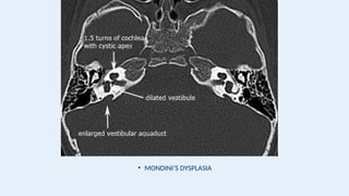 • MONDINI’S DYSPLASIA
 