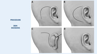 PROCEDURE
SKIN
INCISIONS
 