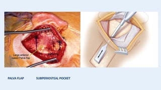 PALVA FLAP SUBPERIOSTEAL POCKET
 