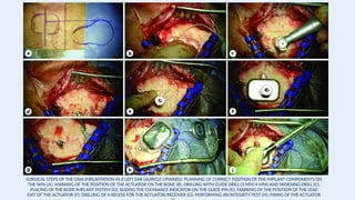 SURGICAL STEPS OF THE OSIA IMPLANTATION IN A LEFT EAR (AURICLE UPWARD): PLANNING OF CORRECT POSITION OF THE IMPLANT COMPONENTS ON
THE SKIN (A); MARKING OF THE POSITION OF THE ACTUATOR ON THE BONE (B); DRILLING WITH GUIDE DRILL (3 MM/4 MM) AND WIDENING DRILL (C);
PLACING OF THE BI300 IMPLANT SYSTEM (D); SLIDING THE CLEARANCE INDICATOR ON THE GUIDE PIN (E); MARKING OF THE POSITION OF THE LEAD
EXIT OF THE ACTUATOR (F); DRILLING OF A RECESS FOR THE ACTUATOR/RECEIVER (G); PERFORMING AN INTEGRITY TEST (H); FIXING OF THE ACTUATOR
 