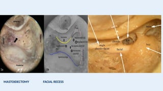 MASTOIDECTOMY FACIAL RECESS
 