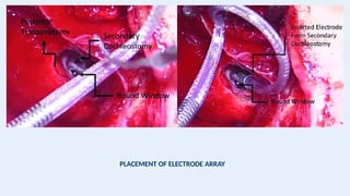 PLACEMENT OF ELECTRODE ARRAY
 
