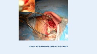 STIMULATOR/RECEIVER FIXED WITH SUTURES
 