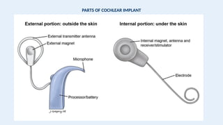 PARTS OF COCHLEAR IMPLANT
 
