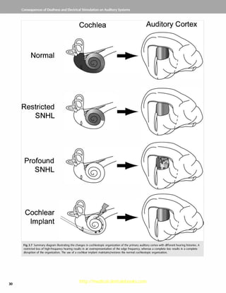 Cochlear implants: Indications, Investigation , Surgery | PDF