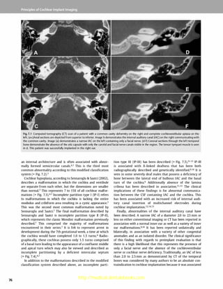 Cochlear implants: Indications, Investigation , Surgery | PDF