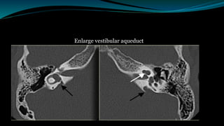 Enlarge vestibular aqueduct
 
