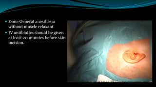 Done General anesthesia
without muscle relaxant
 IV antibiotics should be given
at least 20 minutes before skin
incision.
 