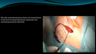 The skin and subcutaneous tissue are incised down
to the level of temporalis fascia superiorly and
mastoid periosteum inferiorly
 