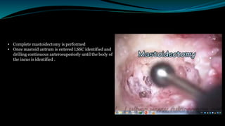 • Complete mastoidectomy is performed
• Once mastoid antrum is entered LSSC identified and
drilling continuous anterosuperiorly until the body of
the incus is identified .
 