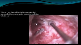 Using 1-3 mm diamond burr facial recess is curefully
saucerized with copious irrigation to avoid thermal injury
to facial nerve
 